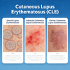 Mod&egrave;les de lupus &eacute;ryth&eacute;mateux cutan&eacute; (CLE) chez la souris