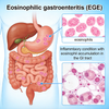 Model gastroenteritis eosinofilik tikus (EGE).