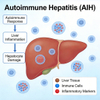 Mod&egrave;les d’h&eacute;patite auto-immune de souris (AIH)
