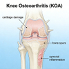 Panya Knee Osteoarthritis (KOA) Models