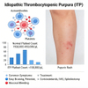 idiopathic thrombocytopenic purpura (ITP) ၏မောက်စ်ပုံစံ