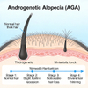 Modelos de alopecia androgen&eacute;tica en rat&oacute;n (AGA)