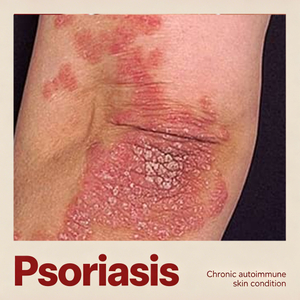 NHP psoriasis exemplar