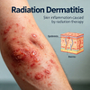 Rotbestralingsdermatitis (RD) modelle
